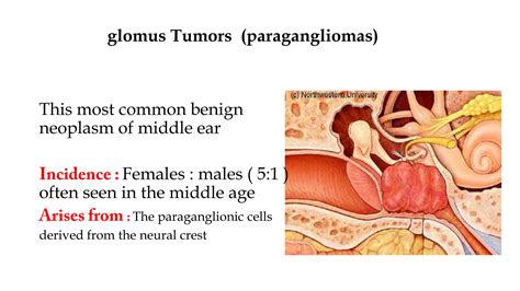 Common Middle Ear Tumors Ppt