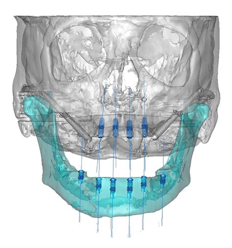 Planificaci N D En Implantes Dentales Instituto Maxilofacial