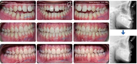 Can We Treat Challenging Malocclusions With Invisalign The Ortho Cosmos