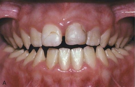 Hypoplastic Amelogenesis Imperfecta Autosomal Dominant MEDizzy