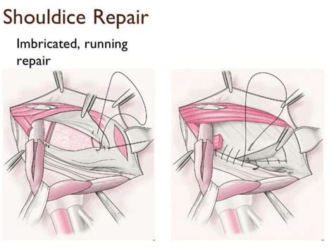 Inguinal hernia repair