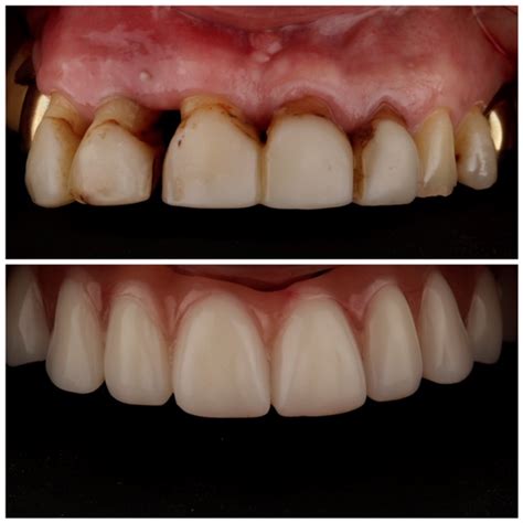 Pr Tesis Fija De Cer Mica Sobre Implantes Dentales Fotos Y Caso Real