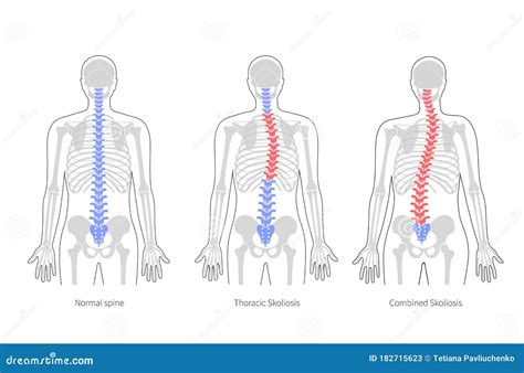 Scoliosis Flat Vector Illustration Stock Vector Illustration Of