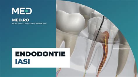 Endodontie Iasi Top Clinici Pre Uri Programare Online