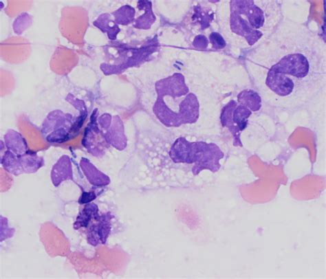 Degenerate Neutrophils Eclinpath 52 Off