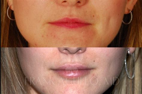 Is Lip Fat Transfer Permanent Infoupdate Org