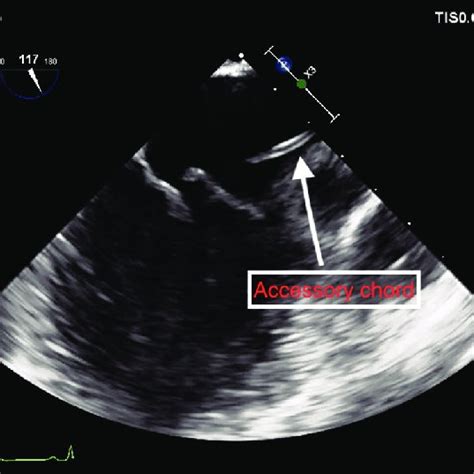 Surgical Image Of The Chorda Attaching To The A2 Segment Of The
