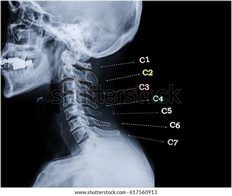 Film Xray Cspine Lateral View Cervical Stock Photo Edit Now 617560913