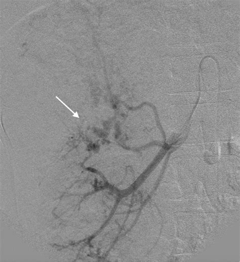 Digital Subtracted Angiography Of Right Renal Artery Showing Multiple Download Scientific