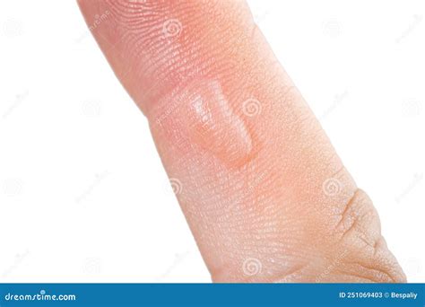 On Hand Finger There Is Blister Callus Or Abscess Stock Image Image