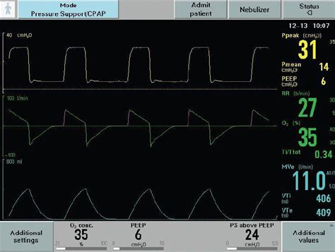 Health Management And Leadership Portal Resuscitation Ventilator