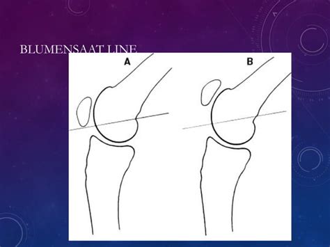 Recurrent Dislocation Of Patella Pawan