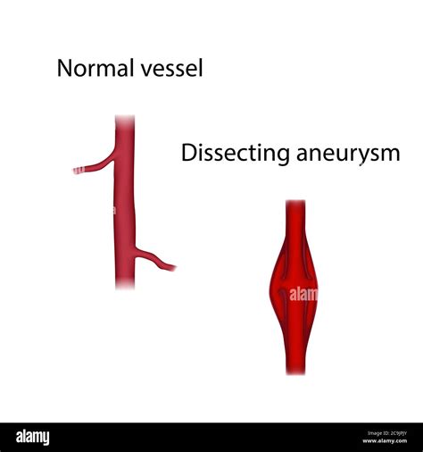 Normal Vessel And Dissecting Aneurysm Comparison Illustration An