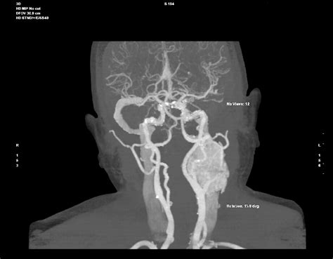 Segmentation From 3d Ct Support 3d Slicer Community