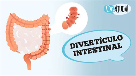 DOENÇA DIVERTICULAR E DIVERTICULITE SINTOMAS DIAGNÓSTICO E TRATAMENTO