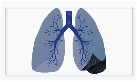 Fibrosis Pulmonar Idiopática – Clínica Pueyrredon