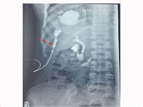 Percutaneous Fisgulography Showing Liver Hydatid Cyst Fistulized To The Download Scientific