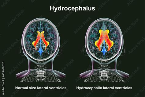 Enlarged and normal lateral ventricles, 3D illustration Stock ...