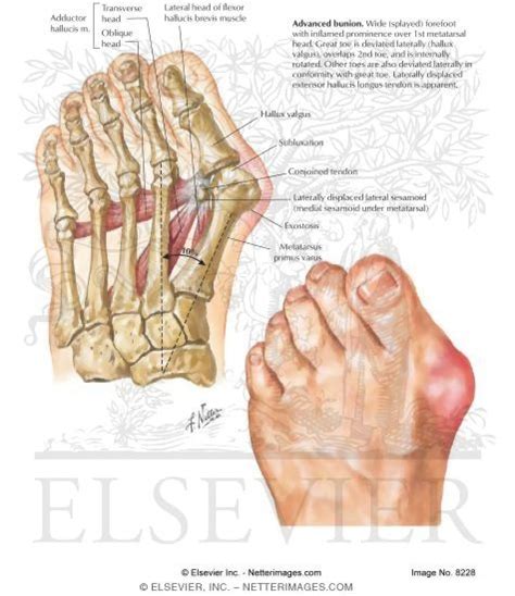 Bunion, Hallux Valgus, and Metatarsus Primus Varus