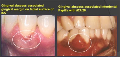 DAOB 323 Exam 1 Perio Gingival And Periodontal Abscess Flashcards