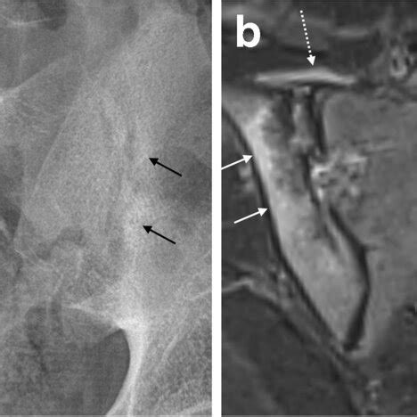 New Sequences For Evaluation Of Sacroiliac Joints On Mri Semicoronal A