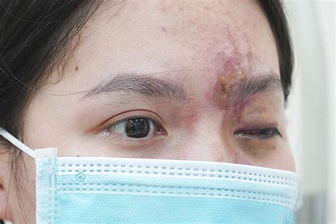 Schock nach Beauty Behandlung in Hanoi 17 Jährige erblindet auf einem Auge