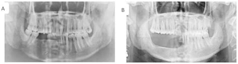 Management Of Mandibular Odontogenic Keratocyst Through Radical