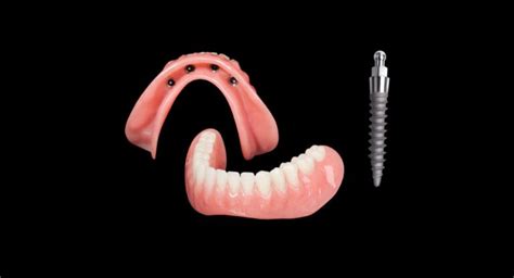 Mini Implant Overdenture Archives Denttech Dental Lab