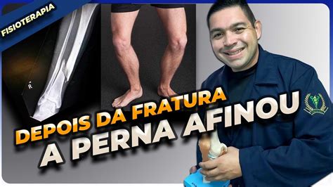 Fratura De T Bia E F Bula Pernas Ficam Finas Atrofia Muscular Youtube