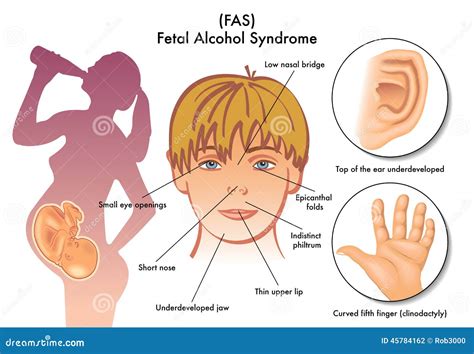 Fetal Alcohol Syndrome Stock Vector Illustration Of Abnormal