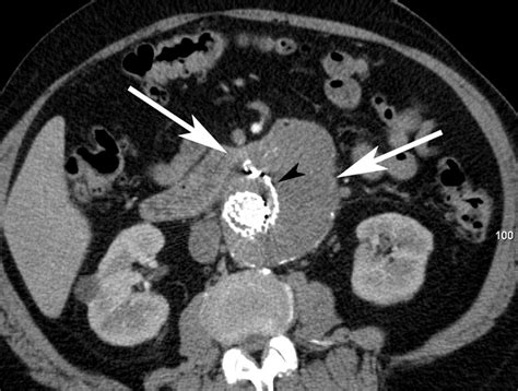 Abdominal Aortic Aneurysms Revisited MDCT With Multiplanar