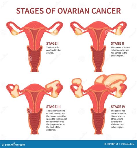 Four Stages Of Womans Ovarian Cancer Isolated Stock Vector