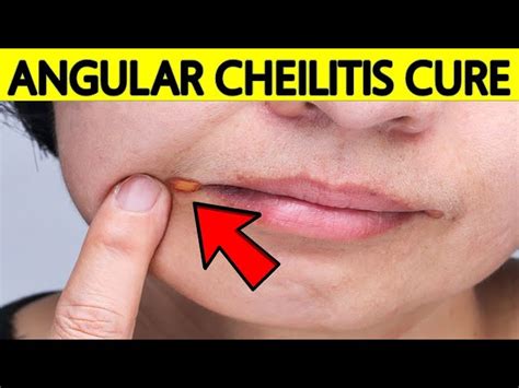 Angular Cheilitis Treatment