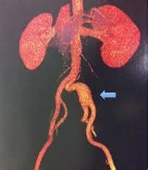 Angiotomografia De Aorta Abdominal Efic Cia No Diagn Stico De