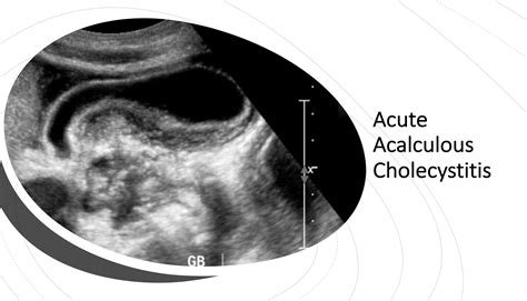 EmDOCs Net Emergency Medicine EducationAcute Acalculous Cholecystitis