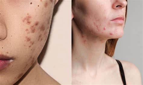 Hormonal Acne Vs Bacterial Acne Which Do You Have