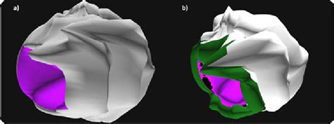 The 3D neuroanatomical reconstruction of dentate nucleus gross ...