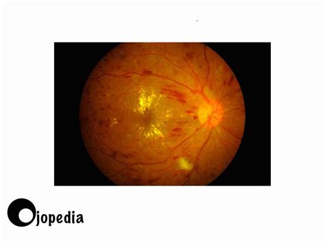 Edema Macular Causas Diagn Stico Y Tratamiento En Ojopedia