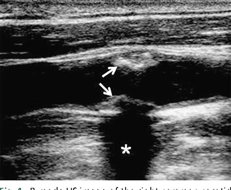 Figure 1 From Noninvasive Carotid Artery Imaging With A Focus On The