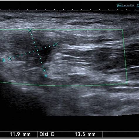 Fig Ultrasound Scan Showing Pubic EnthesopathyĂ Download Scientific Diagram