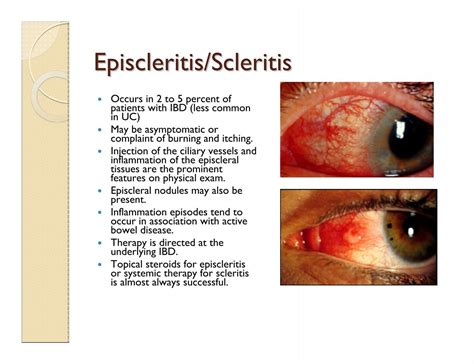 Episcleritis Scleritis