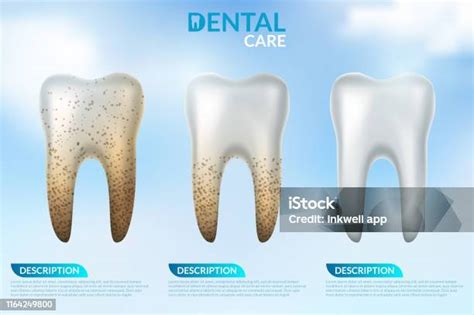 Teeth Whitening 3d Concept Comparison Of Clean And Dirty Tooth Before ...