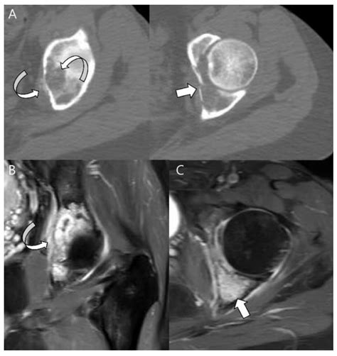 Cancers Free Full Text Classification Of Chondrosarcoma From