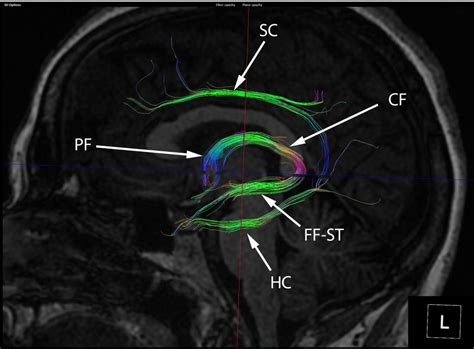 Diffusion Tractography Of The Fornix Neurography Institute