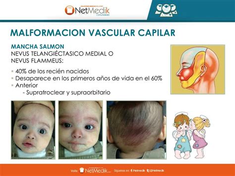 Ppt Alteraciones Vasculares En La Infancia Powerpoint Presentation