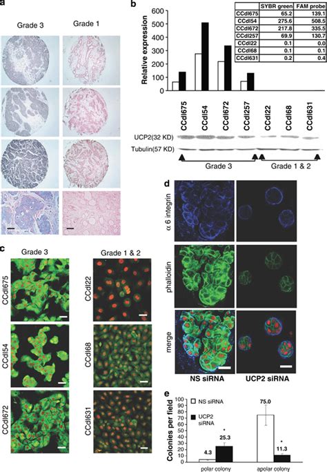 Ucp Is Differentially Expressed By Primary Breast Cancer Of Varying