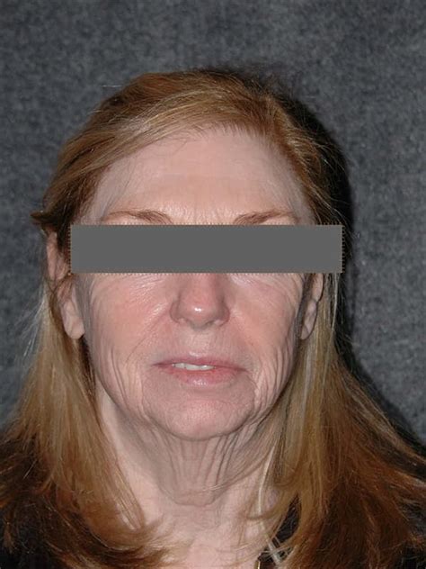 Facelift Before After Patient Dr O Connor