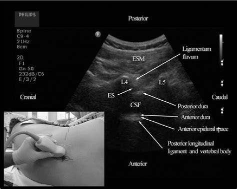 Table 2 From Real Time Ultrasound Guided Paramedian Epidural Access Evaluation Of A Novel In