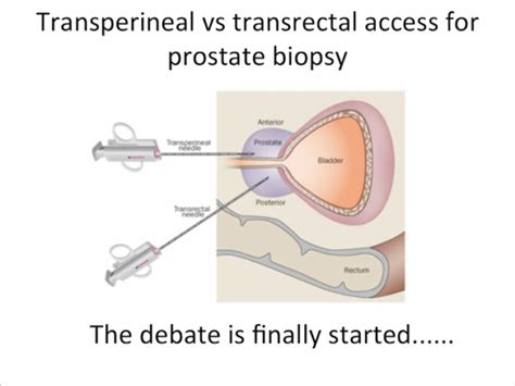 Roberto Miano Md Transperineal Prostate Biopsy State Of The Art