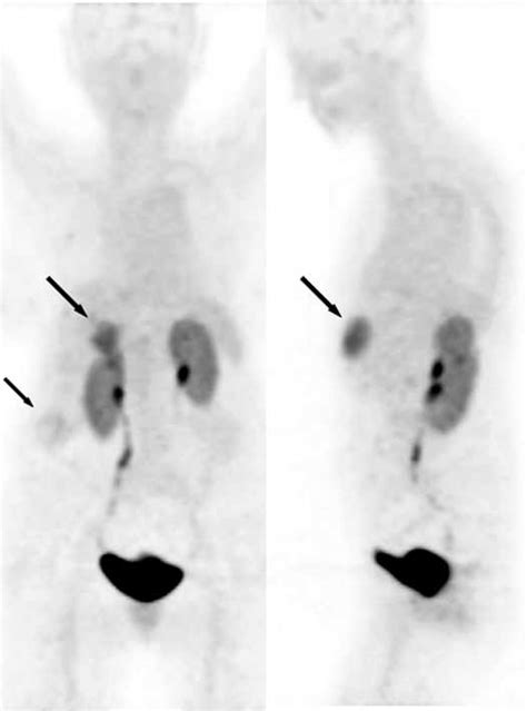 Ga Dotatoc Pet Ct Maximum Intensity Projection Images Front And